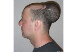 Kepala Pria Ini Digelembungkan Jadi Balon Agar Rambutnya Tumbuh Lagi