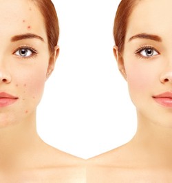 Tips Bebas Jerawat yang Bisa Dilakukan Sehari-hari