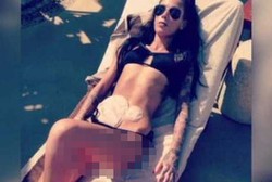 Mantan Model Ini Tak Malu Meski Pakai Kantong Kolostomi