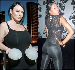 Cerita Tragis 5 Wanita yang Gagal Melakukan Pembesaran Bokong