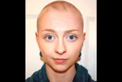 Idap Penyakit Langka, Wanita Ini Hobi Mencabuti Rambutnya hingga Botak