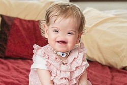 Kisah Tessa, Bocah yang Terlahir Tanpa Hidung dan Tak Bisa Mencium Bau