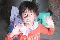 Badan Ditumbuhi Bulu Hitam, Bocah Ini Dijuluki Gadis Kucing