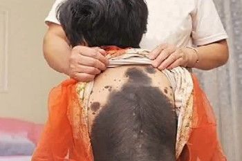 Zhao Xin Rui, Gadis Kucing dengan Bulu Hitam di Sekujur Tubuhnya