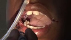 Aneh tapi Nyata: 18 Bulan Sakit Gigi, Ternyata Ada 232 Gigi di Mulut Pemuda ini