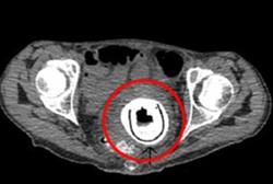 Ya Ampun! Ada Sex Toys Tertanam di Miss V Wanita Ini Selama 10 Tahun