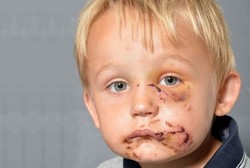 Digigit Anjing Saat Asyik Bermain, Wajah Bocah 4 Tahun Ini Luka Parah