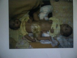 Satu dari Bayi Kembar yang Dirawat di RSHS ini BAB Lewat Anus Buatan