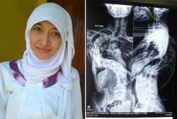 Skoliosis Ekstrem, Lambung dan Paru Ardha Kolaps Terjepit Tulang Belakang