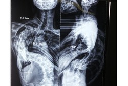 Banyak Orang Percaya Mitos, Skoliosis Dibawa ke Dukun Patah Tulang