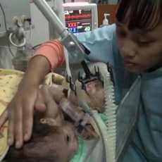 Kondisi Kritis, Bayi Kembar Siam Aldo-Aldi Jalani Operasi Pemisahan