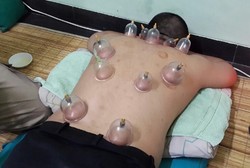 Takut Dibekam Karena Darah? Bekam Juga Bisa Dilakukan Tanpa Luka Kok