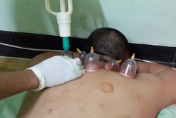 Bekam, Terapi yang Banyak Diminati untuk Usir Penyakit Tanpa Bahan Kimia