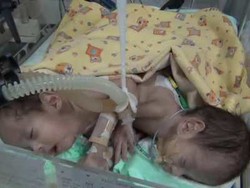 Aldo, Salah Satu Bayi Kembar Siam asal Ponorogo Meninggal