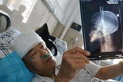 Waduh, Pria Ini Tetap Hidup Meski Kepalanya Tertancap Pisau