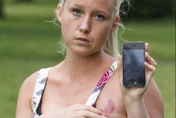 Payudara Wanita Ini Melepuh Jadi Korban iPhone Overheat