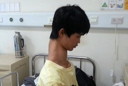 Idap Kelainan Tulang Belakang, Leher Remaja Ini Memanjang di Atas Normal