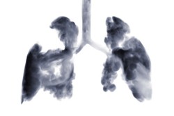 Ini Bedanya Kanker Paru pada Perokok dan Nonperokok