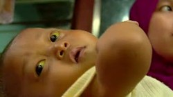 Bayi Ini Butuh Rp 900 Juta untuk Sembuhkan Penyakitnya