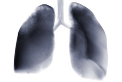 Ini Bedanya Kanker Paru pada Perokok dan Nonperokok