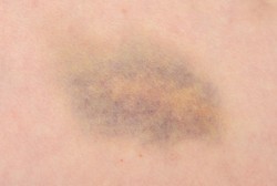 Gejala Hemofilia Sulit Dikenali, Waspada Jika Bayi dan Balita Mudah Lebam