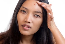 Dari Bawang Putih Hingga Madu, Bahan Ini Bantu Atasi Jerawat di Wajah