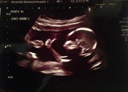 Cute, Bayi Dalam Kandungan Ini Acungkan Jempol Saat USG