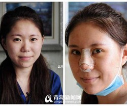 Malas Pakai Make-up, Wanita Ini Pilih Jalani 5 Operasi Plastik