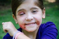 Idap Penyakit Misterius, Kulit Maddie Sering Bengkak dan Lebam Tanpa Sebab