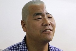 Sempat Separuh Cekung karena Jatuh, Kepala Hu Kini Utuh Berkat Operasi 3D