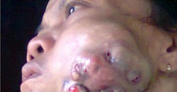 Tolong Sekali, Ibu Kasmah Hanya Buruh Tani Butuh Biaya untuk Operasi Tumor