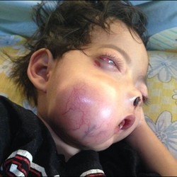 Tolong! Bocah Pengidap Tumor Ganas di Bandung Ini Butuh Bantuan