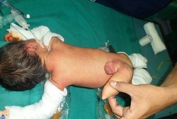 Terlahir dengan Ekor Sepanjang 12 cm, Bayi di India Jalani Operasi 4 Jam