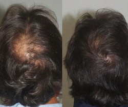 Setelah Facial Vampir, Kini Ada Perawatan Rambut Vampire Hair Lift