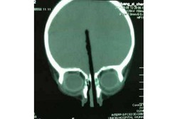 Ya Ampun! Hidung Bocah 2 Tahun Tertusuk Sumpit Hingga Tembus ke Tengkorak