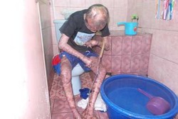 Gampang Mengeras, Kulit Remaja Kulit Ular Harus Dibasuh Tiap 30 Menit