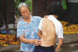 Perlahan Tapi Pasti, Tubuh Gadis ini Membatu Akibat Kelainan Langka