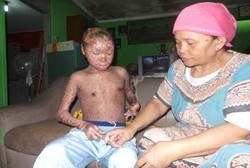 Kulit Biru Hingga Bersisik, Berbagai Orang Dengan Kondisi Kulit Langka