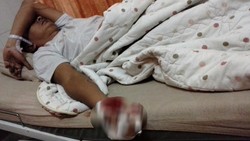 Petasan Meledak di Tangan, Asep Kehilangan Jari Tengah