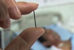 Hii, Bertahun-tahun Jarum Akupunktur Ini Nyangkut di Perut Xu Long