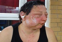 Alergi Pewarna Rambut, Muka Jo Jadi Bengkak dan Matanya Setengah Buta