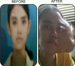 Kisah Anggi dan Tumor Ganas yang Merenggut Kecantikannya