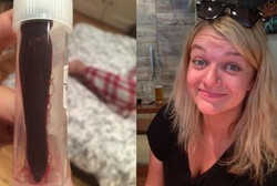 Sering Mimisan, Ternyata Ada Lintah Hidup di Hidung Wanita Ini