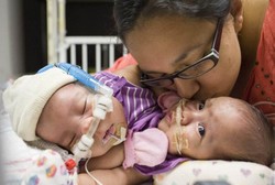 Bayi Kembar Siam Asal Texas Melakukan Operasi Tahap Pertama Pemisahan