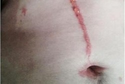 Sepulang dari Bali, Ada Laba-laba Hidup di Kulit Pria Australia Ini