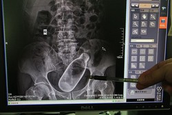 Pria Ini Masukkan Botol ke Dubur untuk Lancarkan BAB Tapi Malah Nyangkut