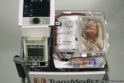 Dokter: Transplantasi Jantung Mati, Jantungnya Tidak Benar-benar Mati