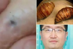 Mengerikan! Belatung Hidup di Bawah Kulit Pria Ini