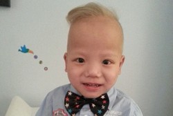 Sindrom Langka Bikin Rambut Bocah Berdarah Asia Ini Pirang Seperti Bule