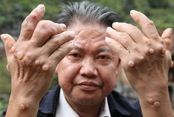 Satu Kampung di Tiongkok Punya Kutil dan Cacat di Kaki dan Tangan